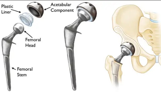 How Long To Recover From Hip Replacement