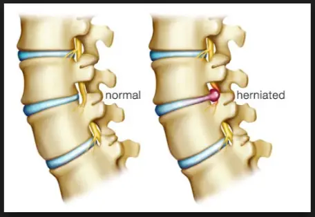What Is a Herniated Disc