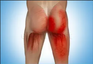 Sore Buttock Muscles Causes: Curing your buttock pain starts with