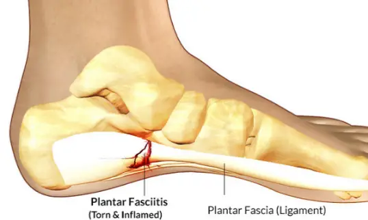 What Does a Heel Spur Look Like? - Body Pain Tips