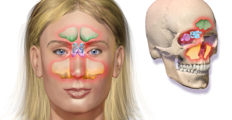 What Can I Do To Relieve My Sinus Pressure