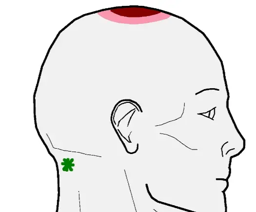 7 Causes Of Headache On Top Of Head And How To Treat It Body Pain Tips