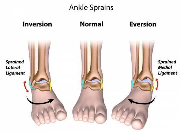 Exercises For Sprained Ankle Ligaments