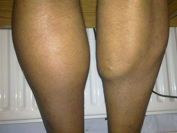 What Does a Pulled Muscle Feel Like