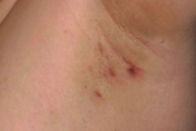 What Causes Armpit Pain