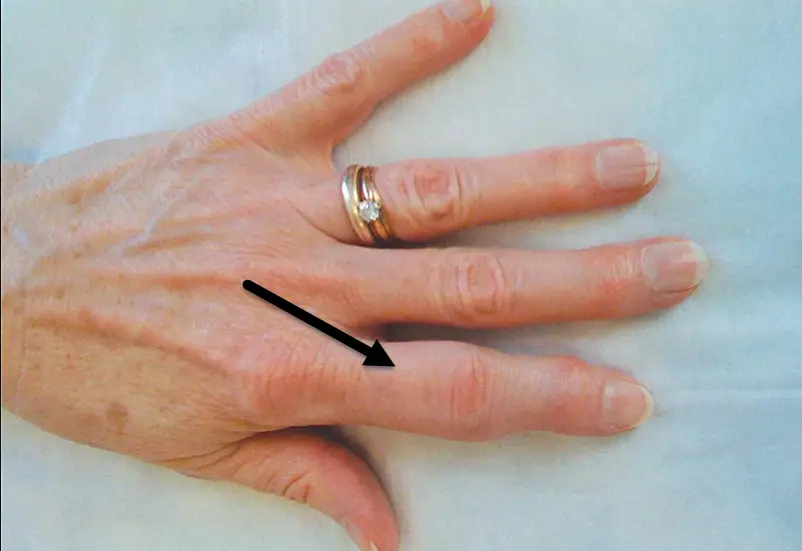 Pointer Finger Knuckle Joint Pain at Janet Grimm blog