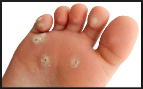 What Does Corns On Feet Look Like