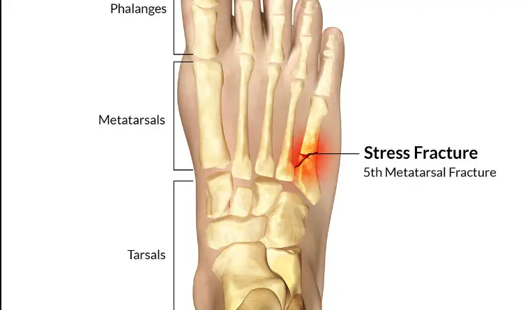 what-does-a-stress-fracture-in-the-foot-feel-like