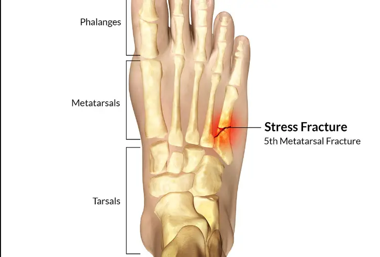 What Does a Stress Fracture in The Foot Feel Like - Body Pain Tips