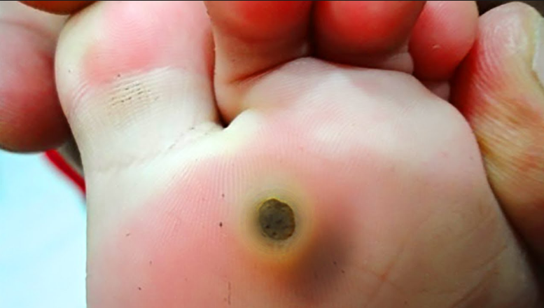 What Does A Beginning Plantar Wart Look Like