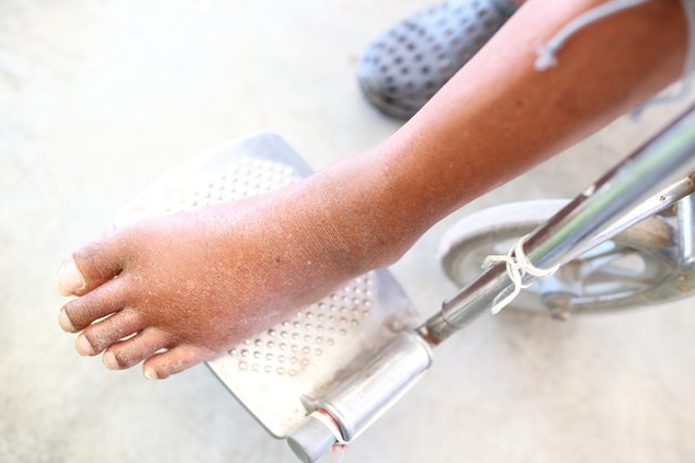 Causes of Ankle Pain and Swelling Tendonitis