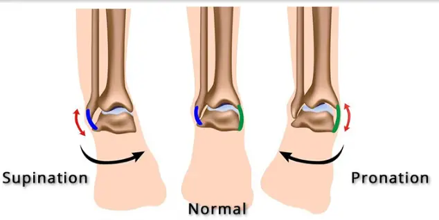 what-does-overpronation-mean