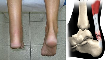 Achilles Tendon Rupture