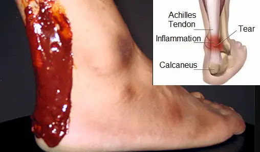 How to Cure Achilles Tendonitis Fast
