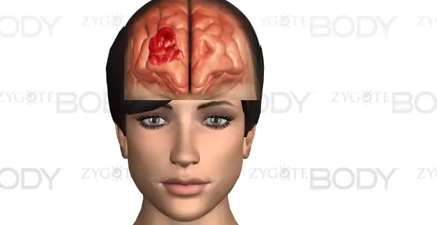 Brain Tumor Headache Characteristics - Body Pain Tips