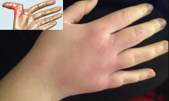 broken knuckle symptoms