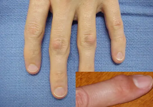 Painful Bumps Finger Joints