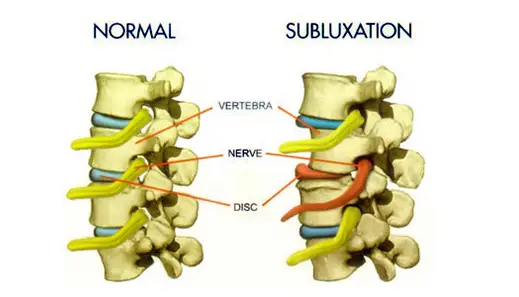 subluxation of the spine