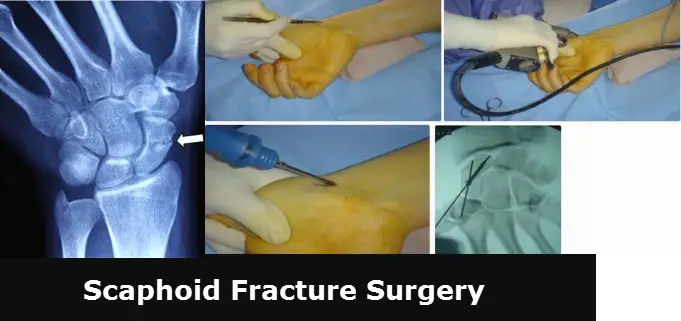scaphoid pain but no fracture