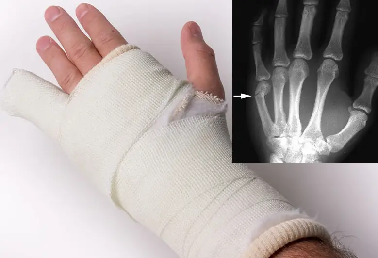 what-are-the-top-5-causes-of-hand-fractures-body-pain-tips