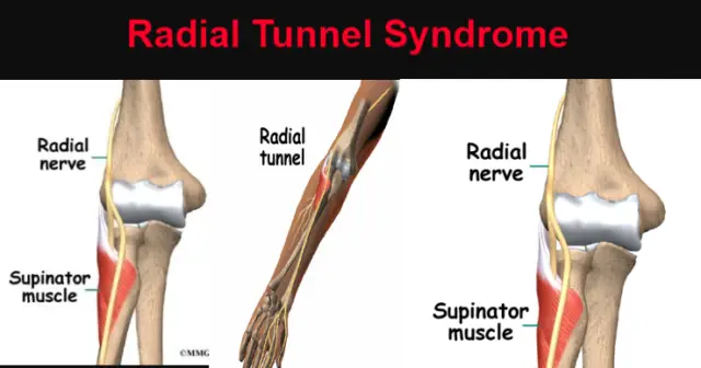 Radial Tunnel Syndrome – Causes, Symptoms, and Treatments