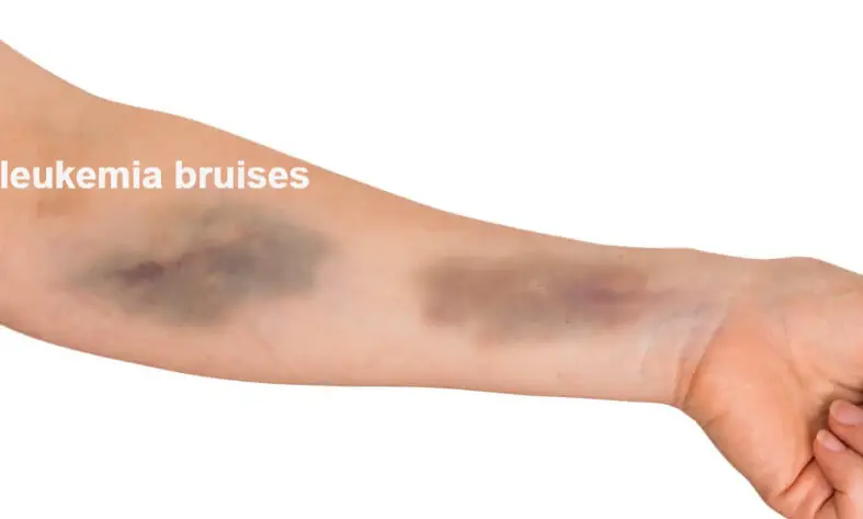 Are Bruises A Sign Of Leukemia What Do Leukemia Bruises Look Like