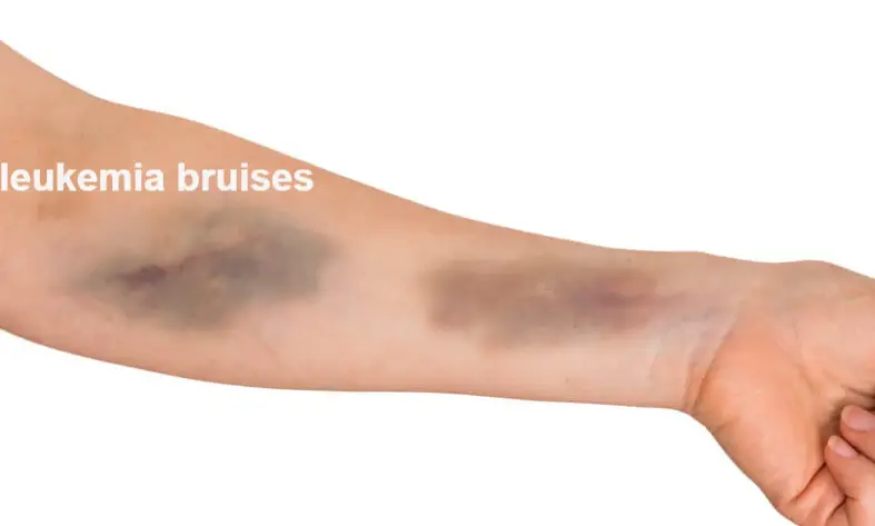 Are Bruises A Sign Of Leukemia What Do Leukemia Bruises Look Like 