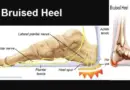 Bruised Heels – Causes & Home Remedies
