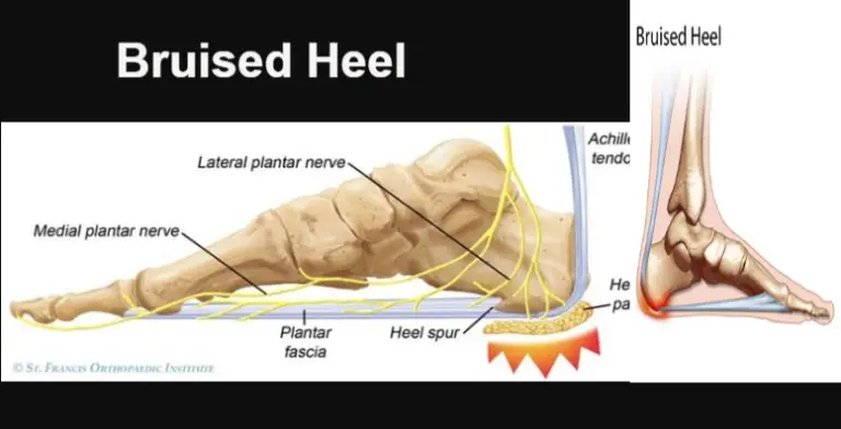 bruised-heels-causes-home-remedies