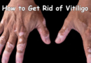 How to Get Rid of Vitiligo – 6 Home Remedies