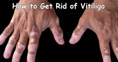 How to Get Rid of Vitiligo – 6 Home Remedies